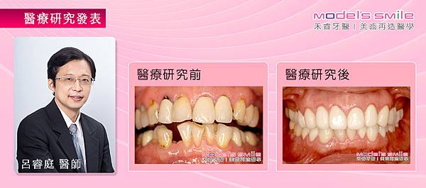 【台北牙醫植牙+全瓷冠案例】缺蛀牙面子不保 植牙美齒改頭換面雪恥