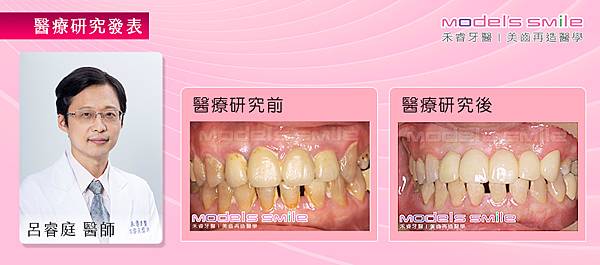 1.(植牙研究報告)【無痛植牙案例】資深教授修前牙 禾睿牙醫現拔現種救門面