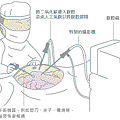 腹腔鏡手術.gif