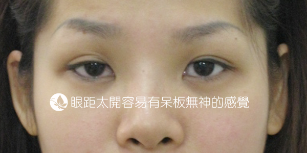 眼距太開.png 眼距太開.png