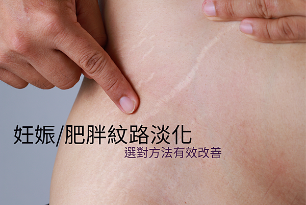 妊娠肥胖紋路.png 妊娠肥胖紋路.png