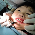 20121226最嚴重的事情發生了！小Ｍｏ上排牙齒內縮到下排牙齒內了！　完全是因為吸奶嘴的關係！！！