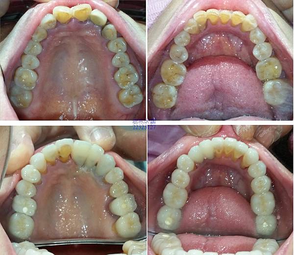 全口重建整合型治療31
