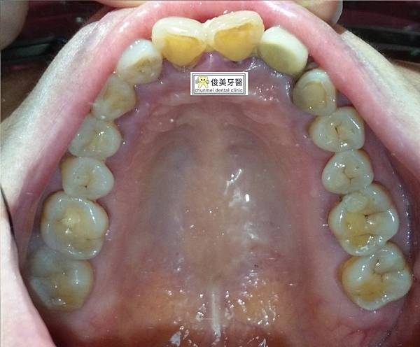 全口重建整合型治療31