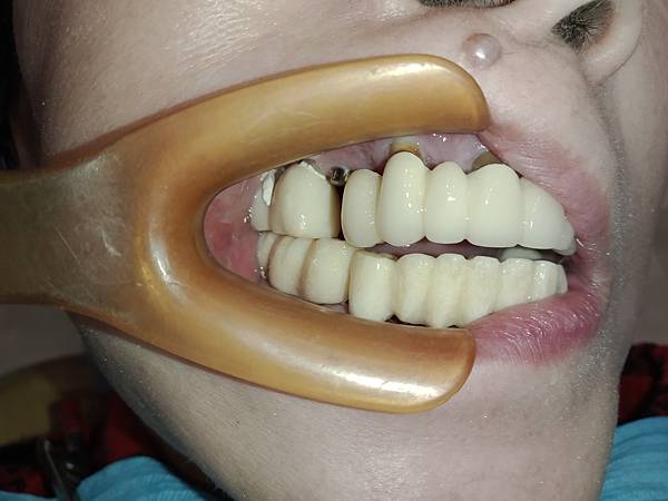 七十歲的牙齒回春術(老年人的牙齒重建)