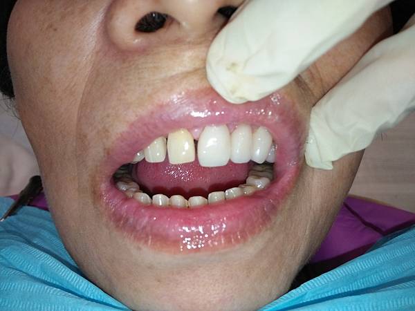 咬合型牙周病該怎麼治療？？