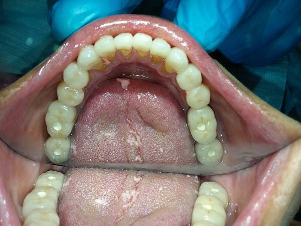 咬合型牙周病該怎麼治療？？