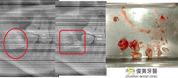 水平埋伏智齒拔牙45