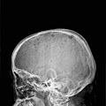 Multiple myeloma-skull.bmp