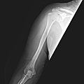 Multiple myeloma-right humerus.bmp