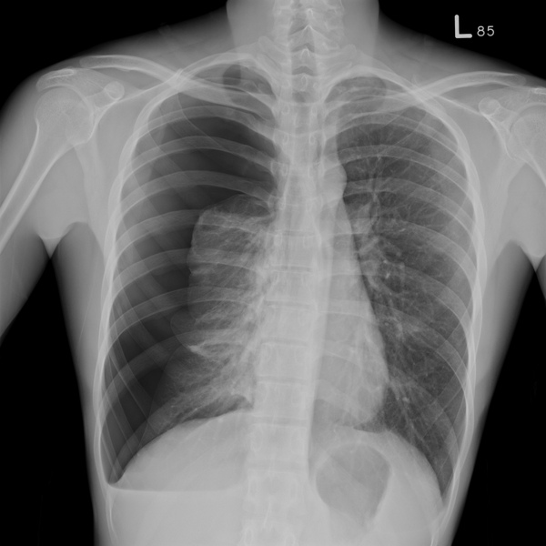 Pneumothorax18YM.bmp