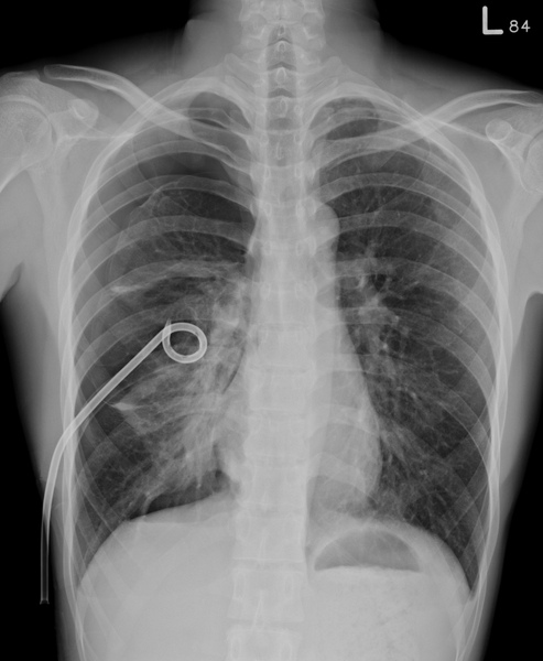 Pneumothorax s/p pigtail drainage.bmp