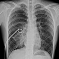 Pneumothorax s/p pigtail drainage.bmp