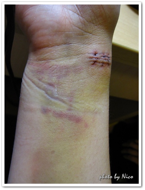 开刀记—腱鞘囊肿