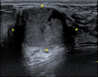 談乳管內乳突瘤 Intraductal Papilloma 陳明鎮醫師乳癌團隊的部落格 痞客邦