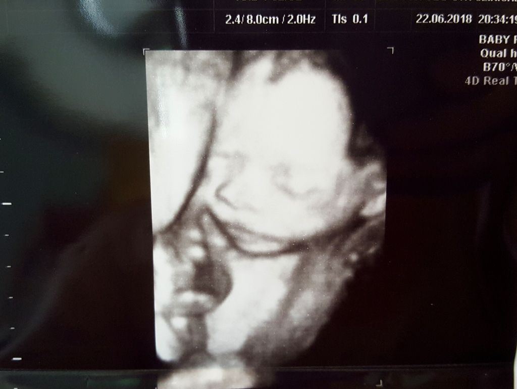 孕二寶 第17週 第22週 性別開獎 台兒診所高層次超音波 媽咪拜mamibuy 孕二寶 第17週 第22週 性別開獎 台兒診所高層次超音波 媽咪拜mamibuy