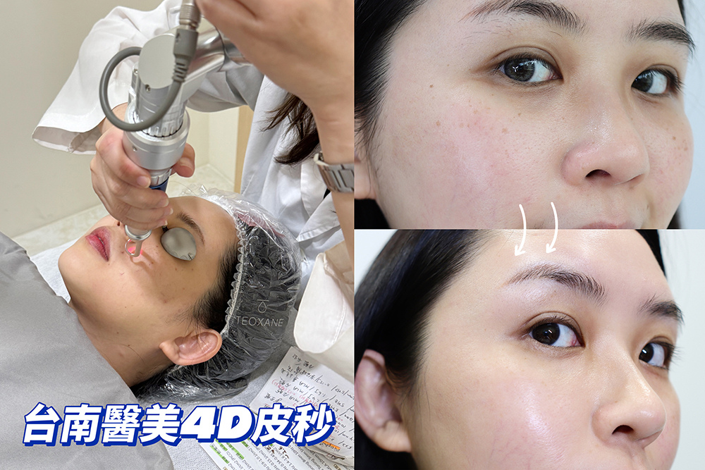 〖醫美紀錄〗雀斑byebye！臉變得更白淨了 美美上美 4D