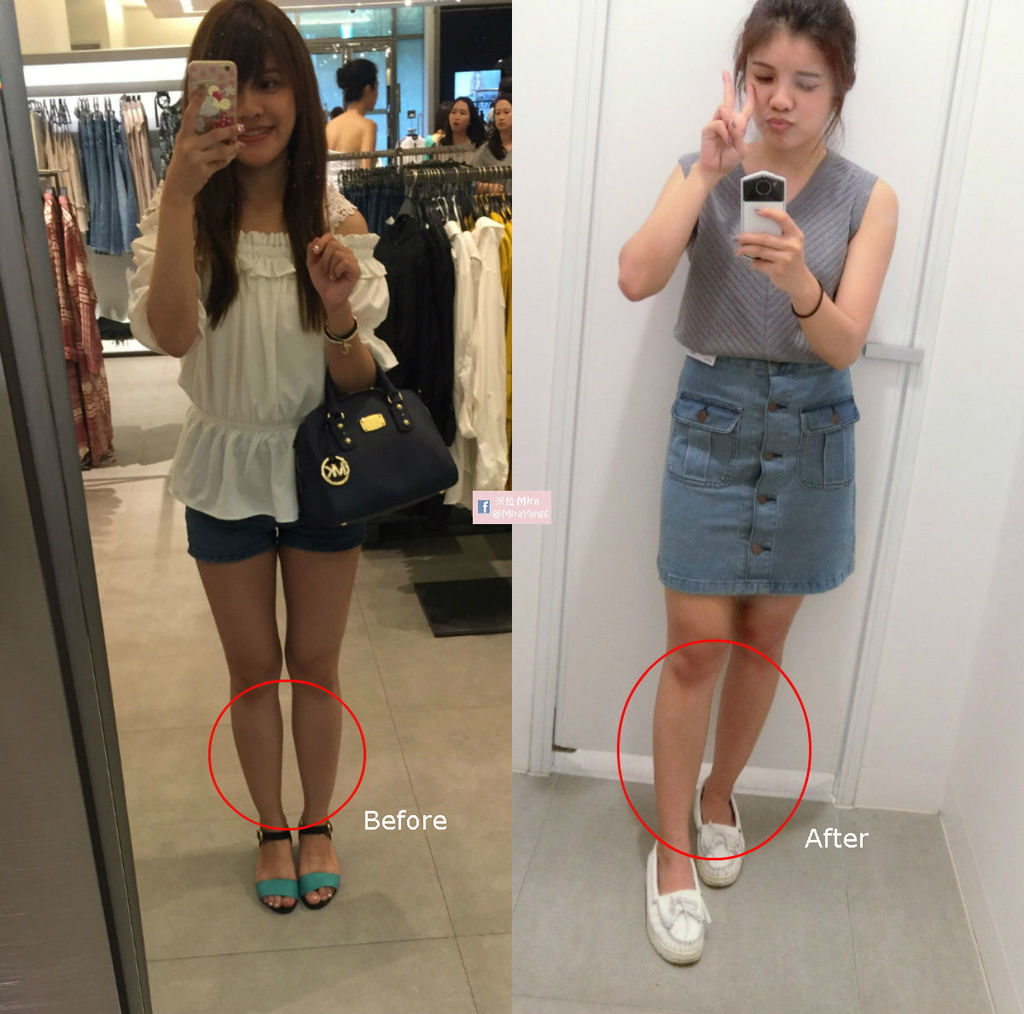 淨妍診所_肉毒小腿12.jpg