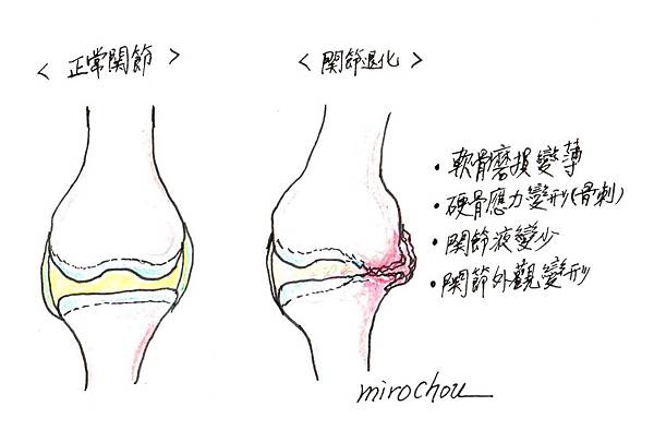 退化關節