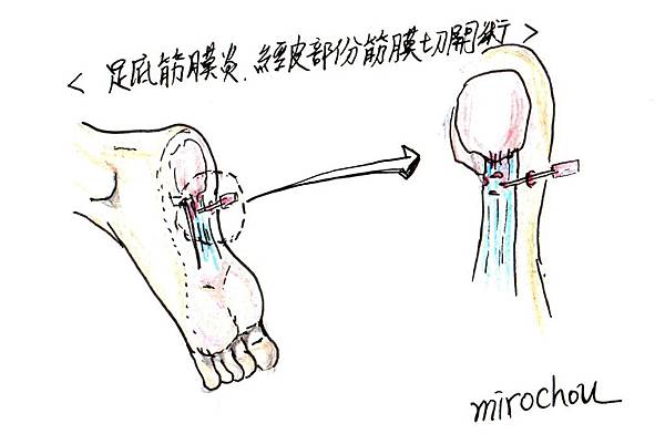 足底筋膜炎手術