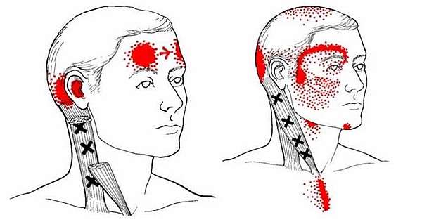 淺談 肌筋膜疼痛症候群 Myofascial Pain Syndrome 獨行的蠍子 痞客邦 淺談 肌筋膜疼痛症候群 Myofascial Pain Syndrome 獨行的蠍子 痞客邦