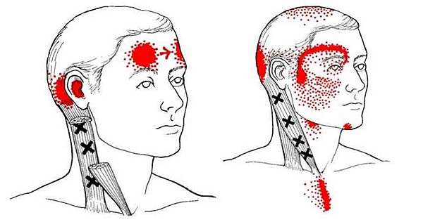 淺談 肌筋膜疼痛症候群 Myofascial Pain Syndrome 獨行的蠍子 痞客邦