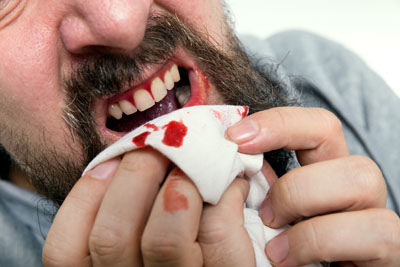 bleeding_gums.jpg