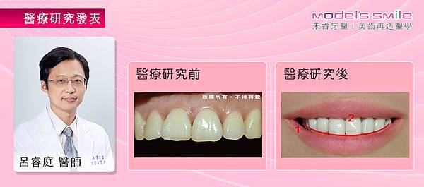 【台北牙醫／星鑽超薄瓷牙貼片案例】齒相影響運勢 星鑽貼片幫修齒型打造微笑曲線