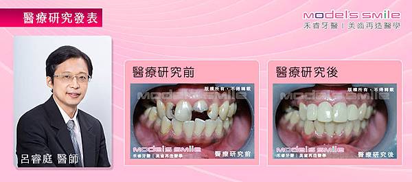 【台北牙醫星鑽全瓷冠醫療案例】蛀牙導致前門牙斷裂 星鑽全瓷冠恢復自然白淨