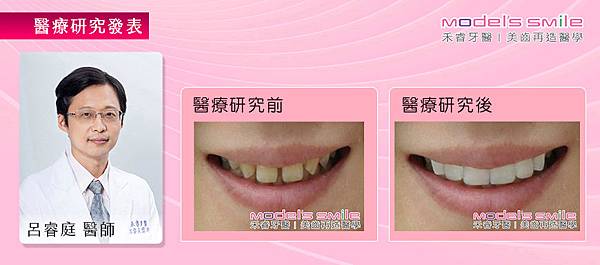 【台北牙醫 星鑽超薄瓷牙貼片案例】 牙黃齒開沒自信 超薄貼片讓牙縫妹變氣質美女