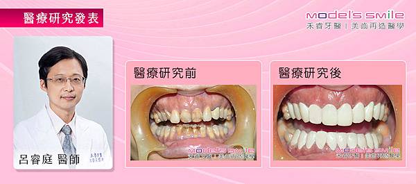 【台北牙醫 星鑽超薄瓷牙貼片案例】 黃牙內縮影響咬合 貼片一掃自卑陰霾