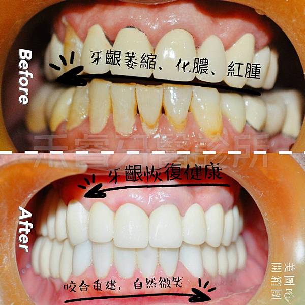 牙周+全瓷冠+貼片-莊小姐