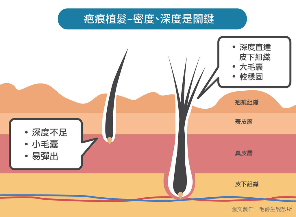 韓式植髮筆植髮手術台北植髮推薦MOJELIM毛爵生髮診所劉怡坊醫師