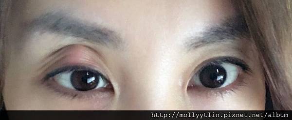 女人知己試用大隊 口碑行銷平台 專家文章分享 澳洲就醫 惱人的霰粒腫 Chalazion 治療紀錄