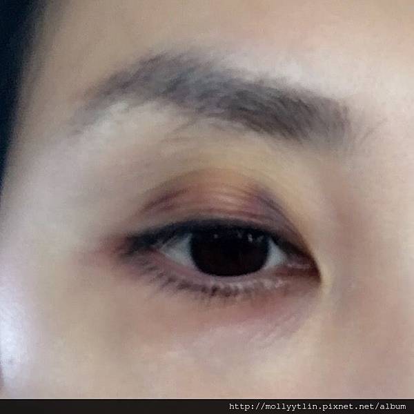 女人知己試用大隊 口碑行銷平台 專家文章分享 澳洲就醫 惱人的霰粒腫 Chalazion 治療紀錄