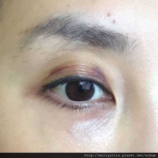 女人知己試用大隊 口碑行銷平台 專家文章分享 澳洲就醫 惱人的霰粒腫 Chalazion 治療紀錄