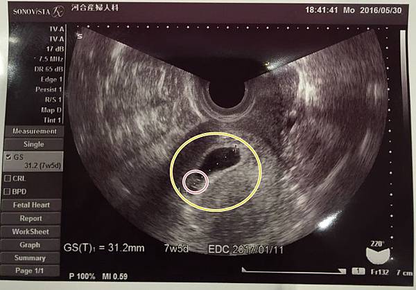懷孕初期 懷孕初期的徵兆 0 16週 Momma Girl Amps 痞客邦