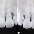 林口牙醫推薦-牙周植牙專科-康澤牙醫-牙齦快爛掉前，終於確定了牙周病治療診所，牙周植牙專科-江明學醫師推薦66.jpg
