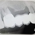 林口牙醫推薦-牙周植牙專科-康澤牙醫-牙齦快爛掉前，終於確定了牙周病治療診所，牙周植牙專科-江明學醫師推薦222.jpg