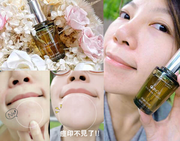 最有效的抗痘保養品指南：擺脫痘痘，重現肌膚光澤