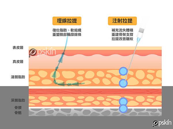 線雕拉提有沒有效果關鍵在_彭禮賢醫師.jpg