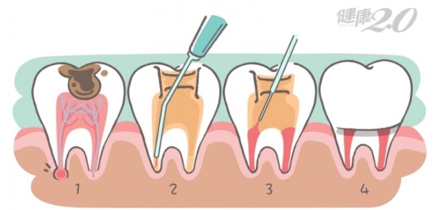 圖片取自健康2.0：醫：根管治療可保住牙齒