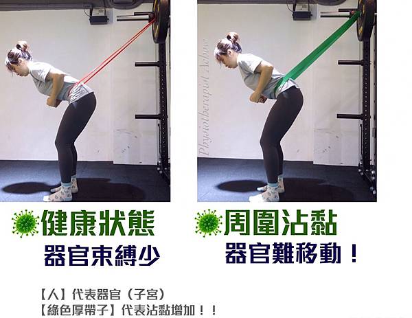 反覆腰痛?經痛?不孕?:子宮沾黏的原因、症狀、與處理方式 沾黏