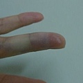 9手指瘀青.JPG