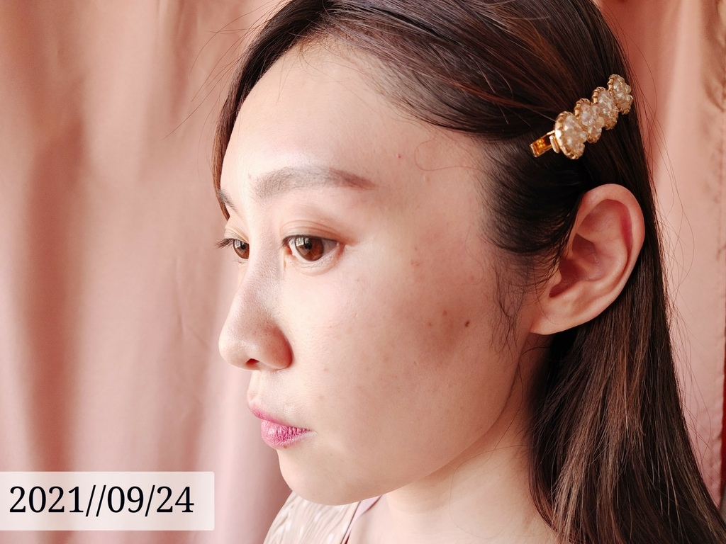 LINE_ALBUM_高雄醫美推薦 BBL寬頻光課程 高雄醫美 麗晶診所 青春光耀 恆淨痘痘 動態除毛 動_26.jpg LINE_ALBUM_高雄醫美推薦 BBL寬頻光課程 高雄醫美 麗晶診所 青春光耀 恆淨痘痘 動態除毛 動_26.jpg