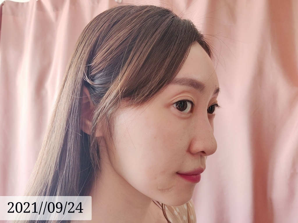 LINE_ALBUM_高雄醫美推薦 BBL寬頻光課程 高雄醫美 麗晶診所 青春光耀 恆淨痘痘 動態除毛 動_25.jpg LINE_ALBUM_高雄醫美推薦 BBL寬頻光課程 高雄醫美 麗晶診所 青春光耀 恆淨痘痘 動態除毛 動_25.jpg