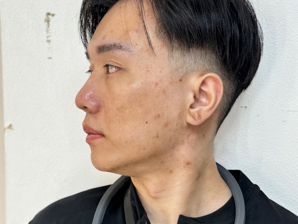 新願美學診所 大安區醫美推薦 郭毅昕醫生 探索皮秒 男生皮秒推薦 毛孔雷射 男生雷射_251203_28 (1).jpg 新願美學診所 大安區醫美推薦 郭毅昕醫生 探索皮秒 男生皮秒推薦 毛孔雷射 男生雷射_251203_28 (1).jpg