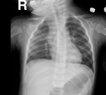 CXR