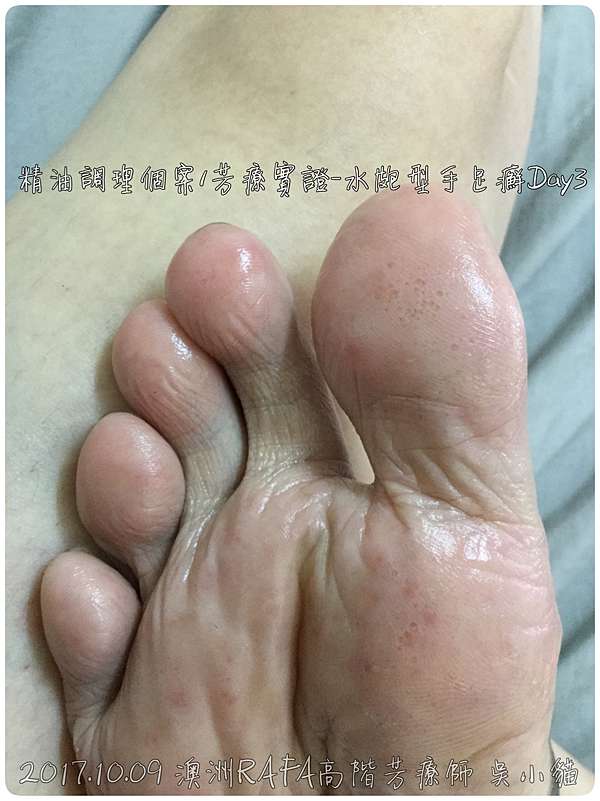 精油個案調理 芳療實證 17 10 07皮膚問題 水皰型手足癬 Day1 Day3 澳洲rafa高階芳療師吳小貓 痞客邦 精油個案調理 芳療實證 17 10 07皮膚問題 水皰型手足癬 Day1 Day3 澳洲rafa高階芳療師吳小貓 痞客邦