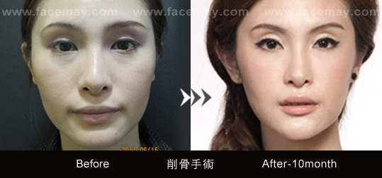 台中削骨 削骨案例.jpg